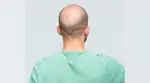 India: Baldness 'cure' leads to traffic jam in UP's Meerut, Police intervene