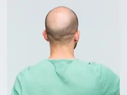 India: Baldness 'cure' leads to traffic jam in UP's Meerut, Police intervene