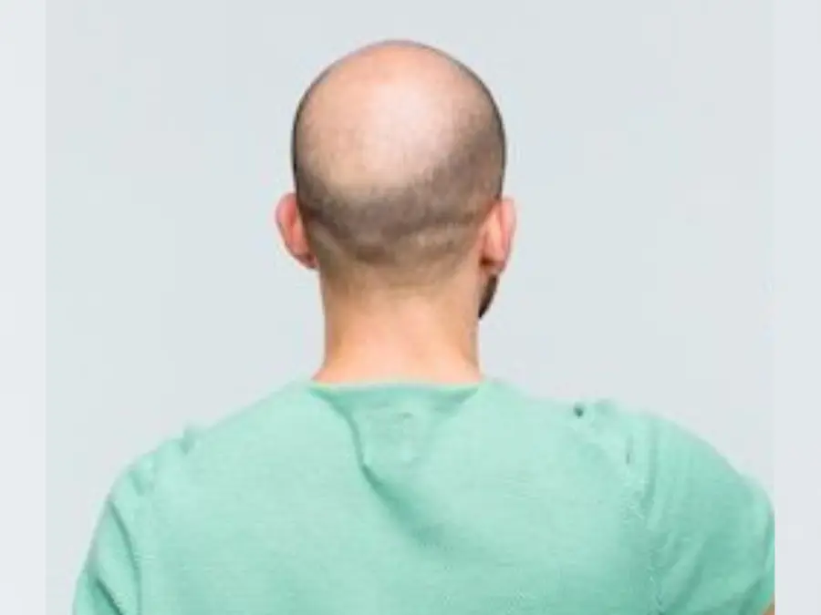 India: Baldness 'cure' leads to traffic jam in UP's Meerut, Police intervene