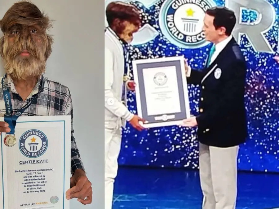 ‘Werewolf Syndrome’: Indian boy secures Guinness World Record for ‘hairiest face’