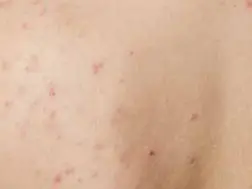 6 quick easy tips to get rid of back acne