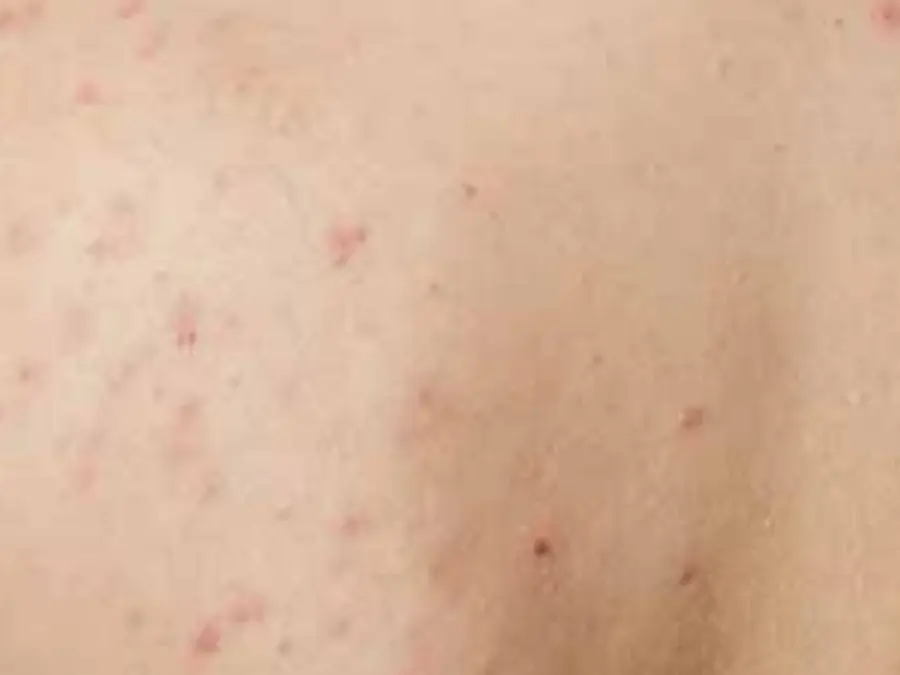 6 quick easy tips to get rid of back acne