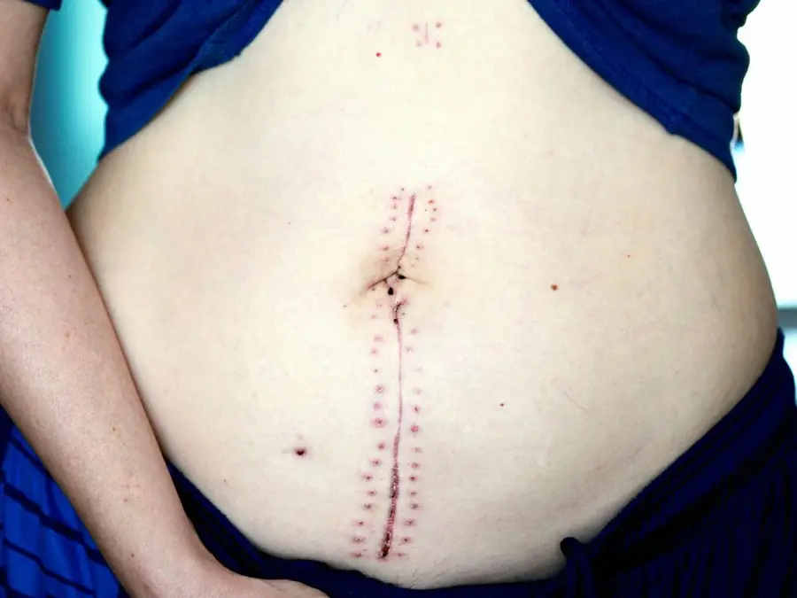 Turkey bans elective C-section births, sparking outrage from rights groups, opposition: ‘Keep your hands off women’s bodies’