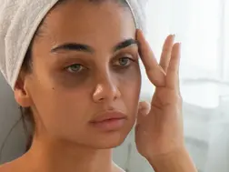 5 Simple Home Remedies to Reduce Dark Circles