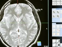 Woman experiencing hot pain in feet diagnosed with worms in brain. 'Fever, confusion...'