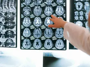 Common medicines may reduce risk of dementia, new study suggests