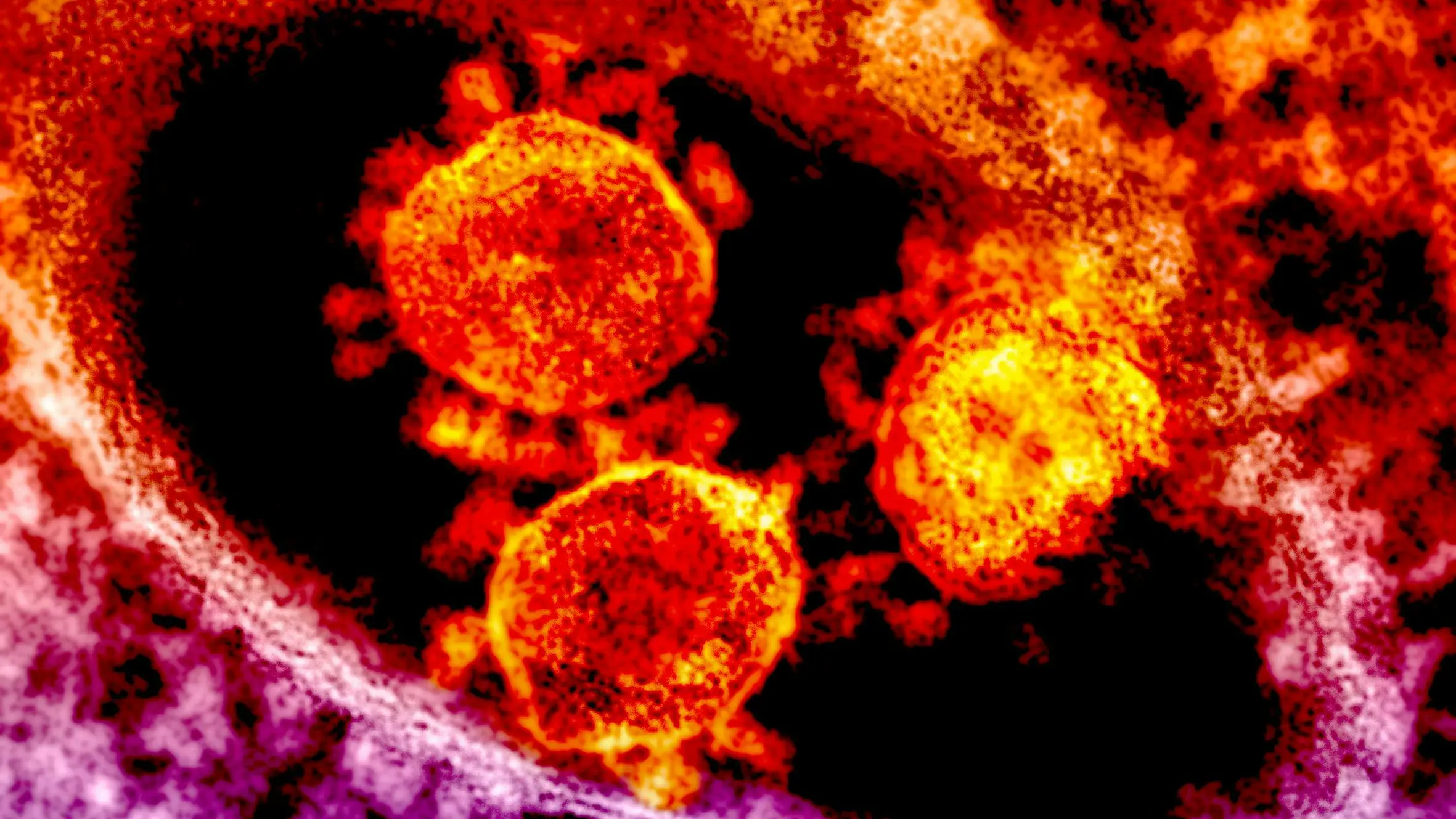 COVID-19 virus reaches 8-year-old girl's brain, putting her in coma before killing her