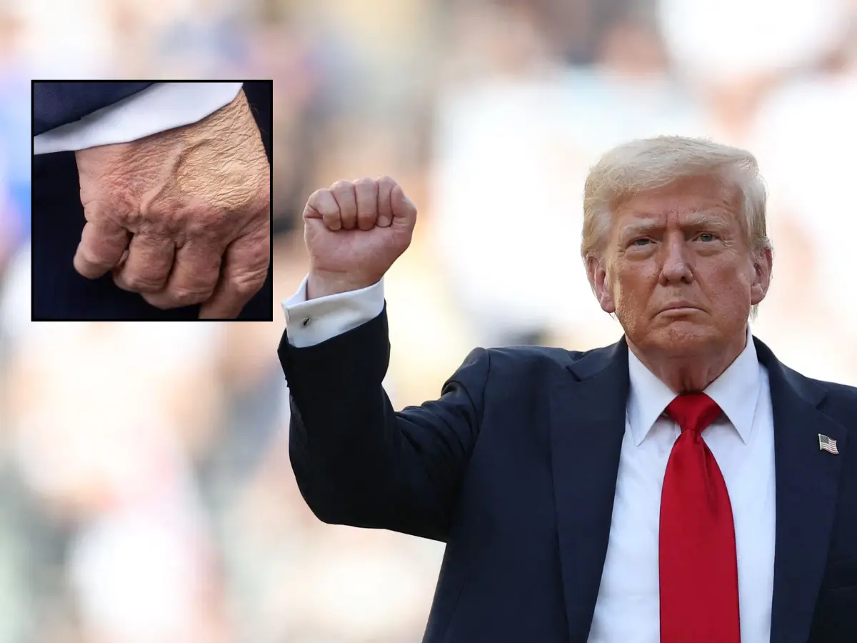 Skin-toned makeup or health issue? Trump's swollen ankles, bruised hands pave way for rumours - Here's what doctors said