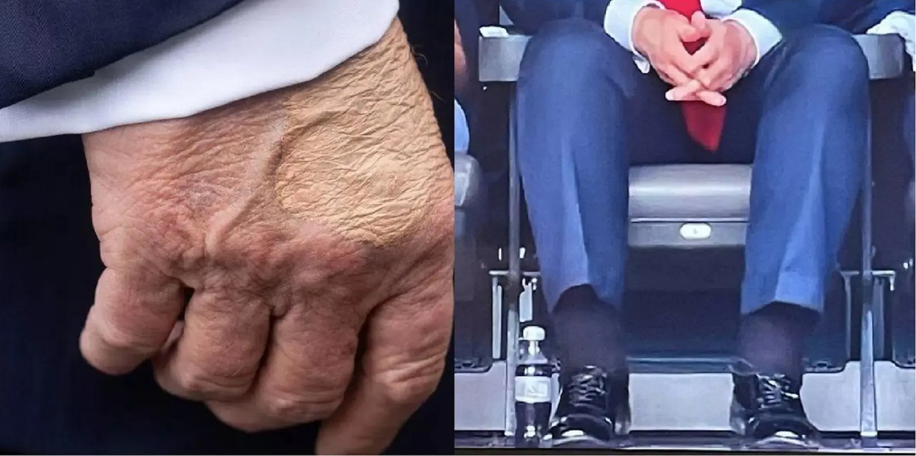 Trump’s ankles swollen due to chronic venous condition, hand bruises due to irritation from ‘handshakes’: White House