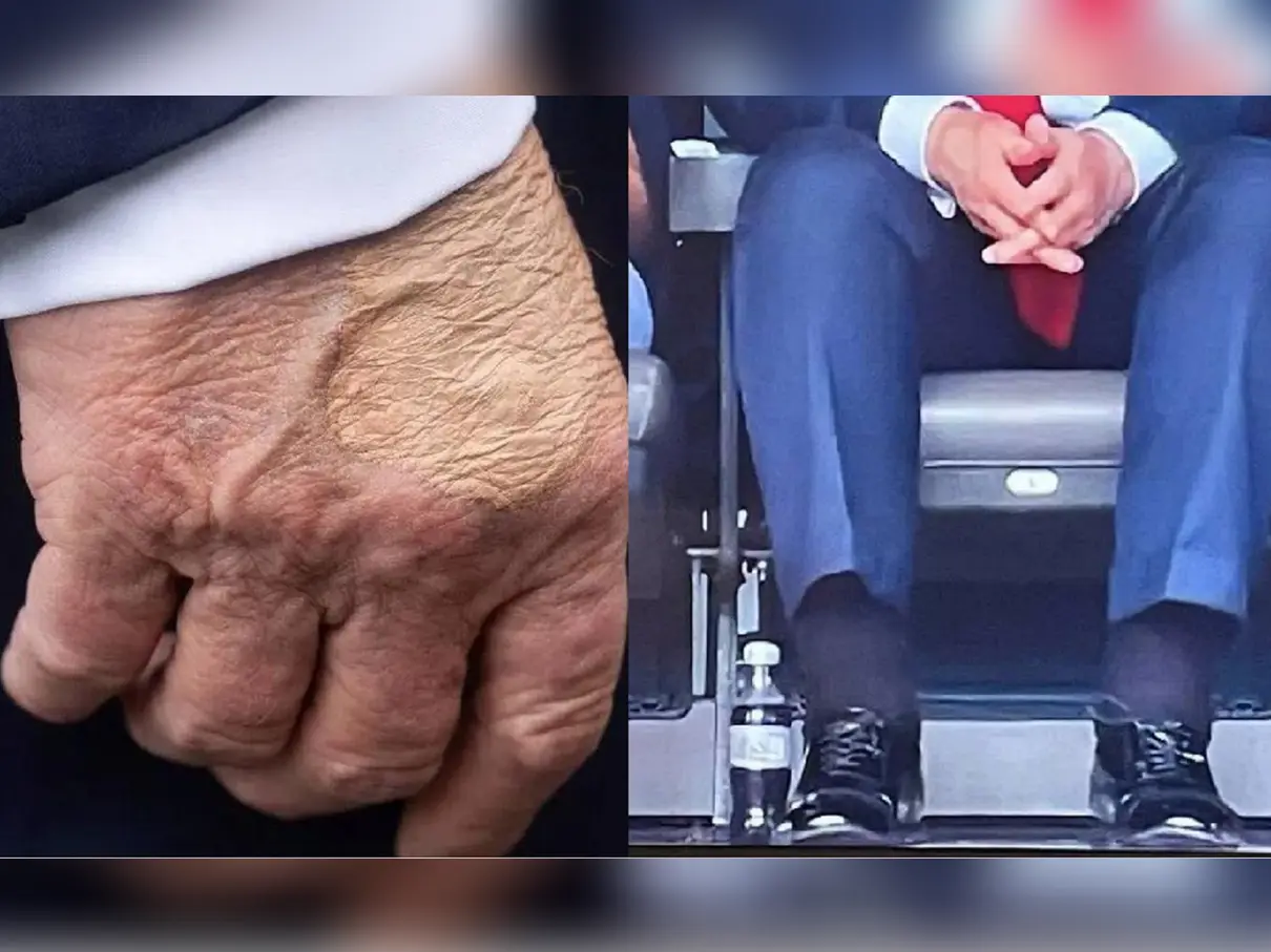 Trump’s ankles swollen due to chronic venous condition, hand bruises due to irritation from ‘handshakes’: White House