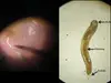 Ocular horror: 'Squiggly worm' raids man's eye in India, doctors vacuum it out