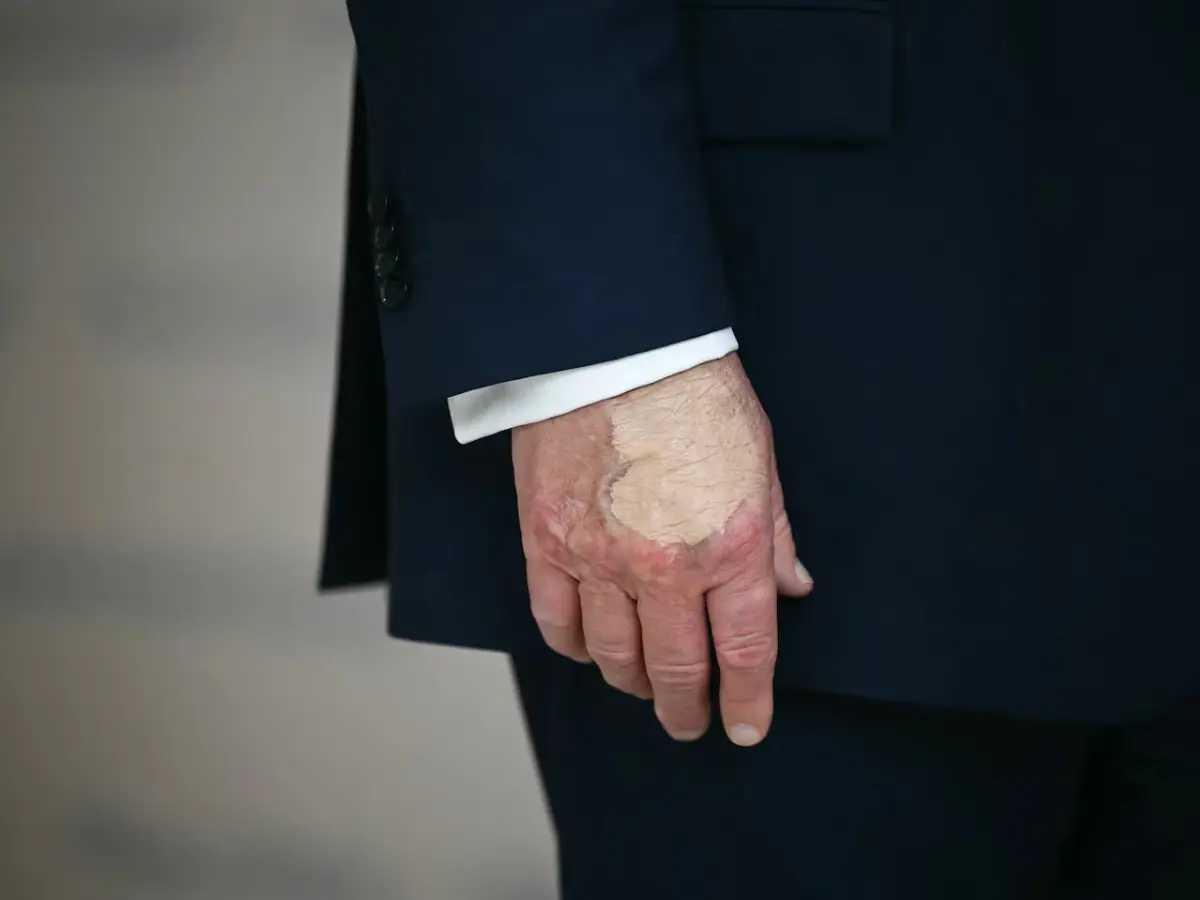 What's Trump hiding? Bizarre hand makeup sparks new health fears after 'Cankles' scandal