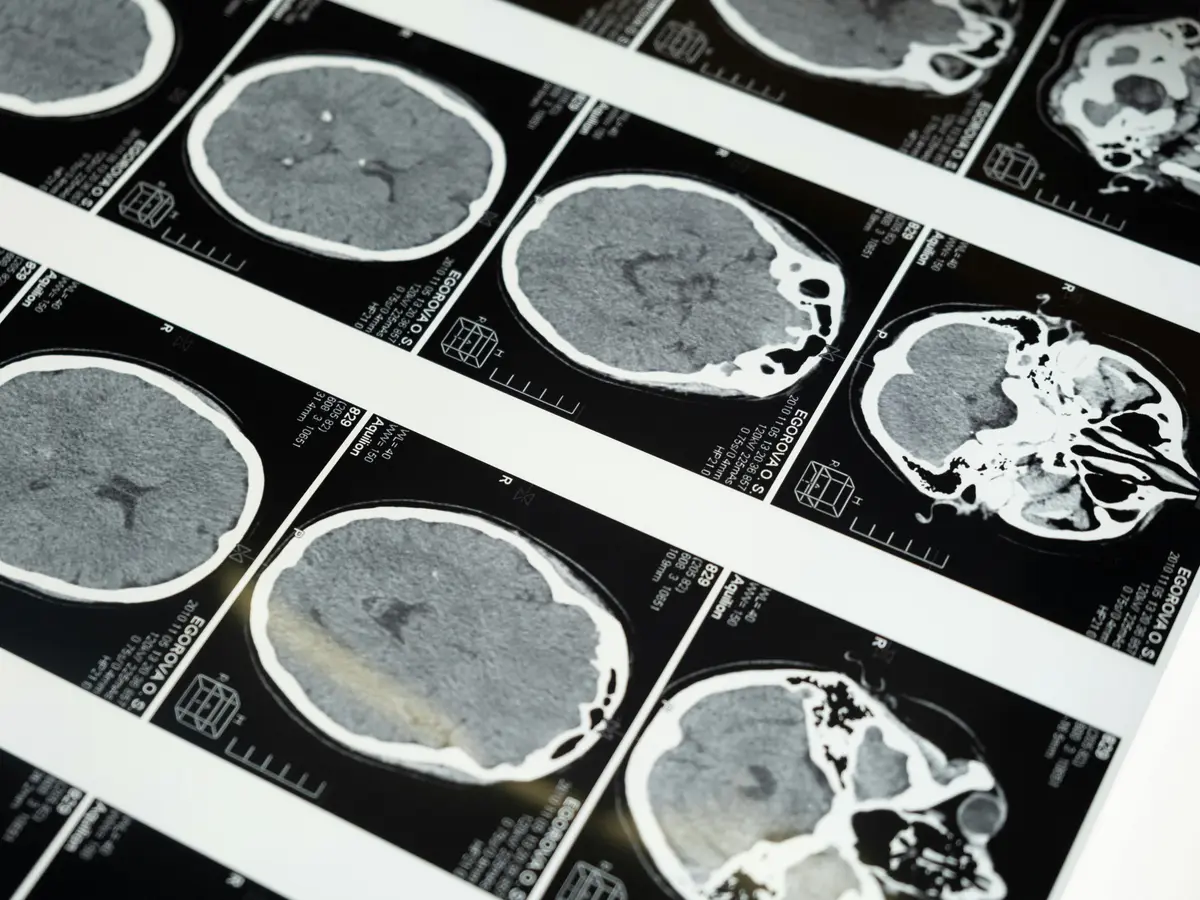 Kiwi Woman's Brain Tumor Vanishes Mysteriously