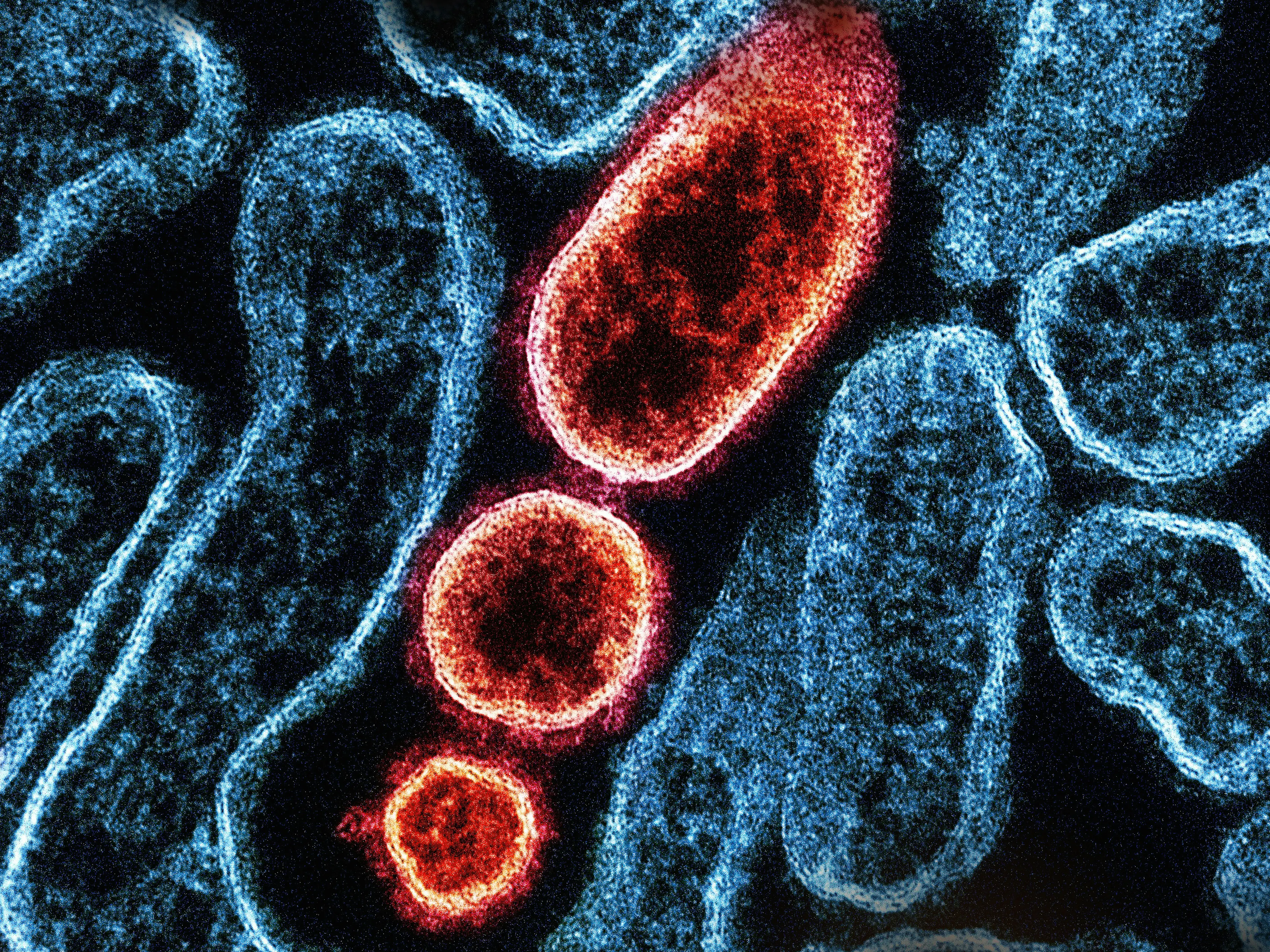 Nipah virus detected in West Bengal? Early symptoms and signs you must know Nipah virus detected in West Bengal? Early symptoms and signs you must know