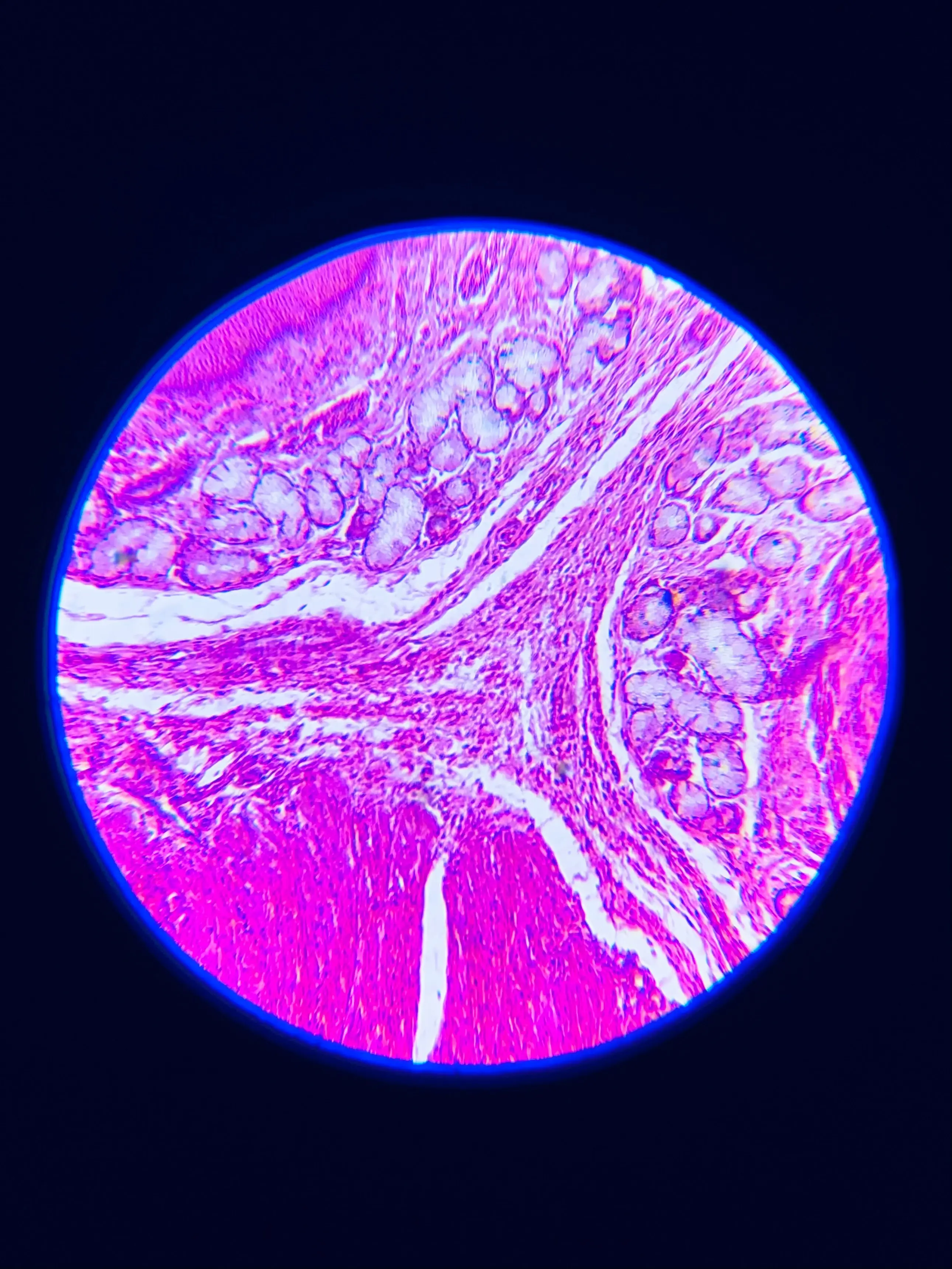 Candida auris infection symptoms