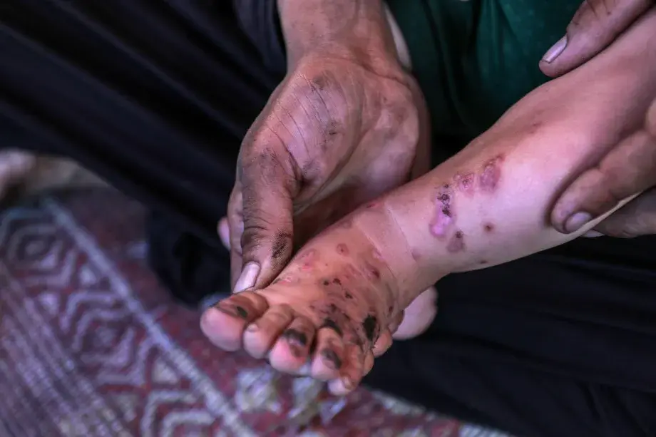 Gaza health crisis worsens as infections triple in displacement camps: UN