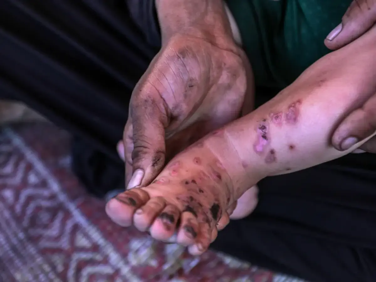 Gaza health crisis worsens as infections triple in displacement camps: UN