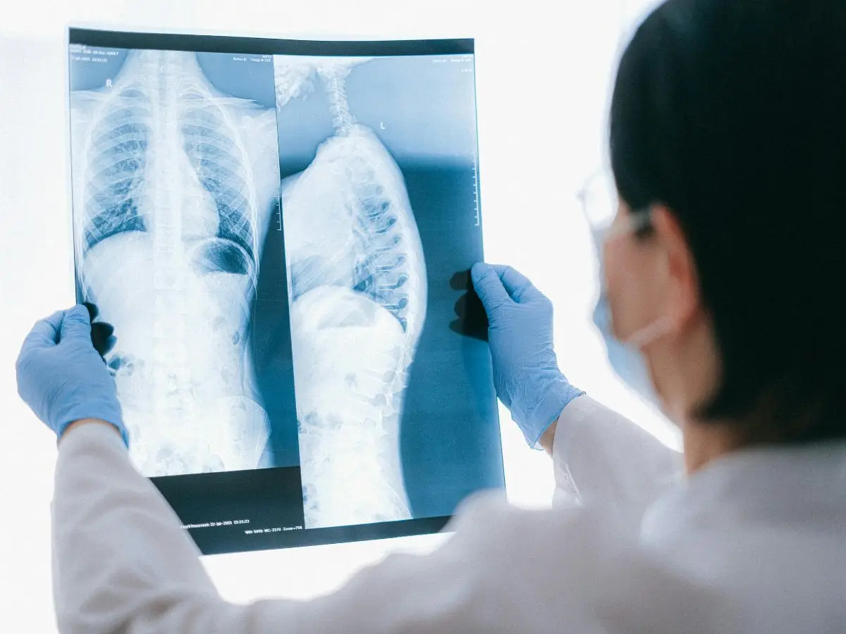 Cystic Fibrosis