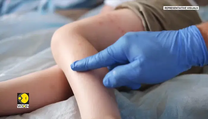 Measles Outbreak Spreads From US to Mexico | Why a Preventable Virus Is Spreading Again