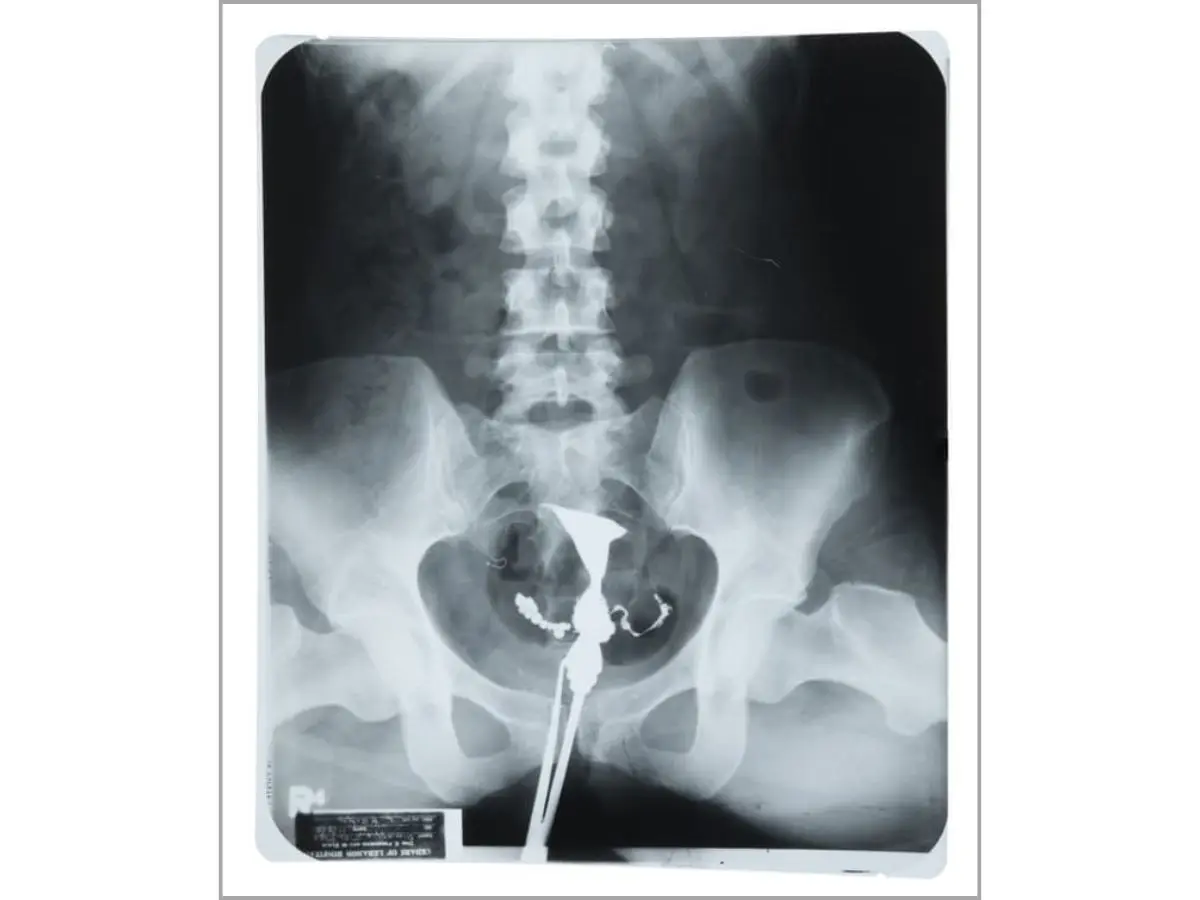 Psychiatrist letters, lingerie along with X-ray