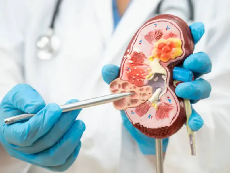 Why Kidney stone cases rise sharply in summer - and how to protect yourself | Expert explains