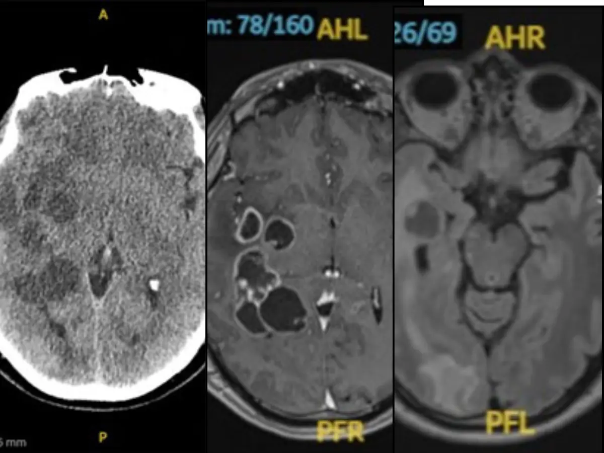 Worms in Spanish man's brain puzzle doctors as no clear cause is revealed Worms in Spanish man's brain puzzle doctors as no clear cause is revealed