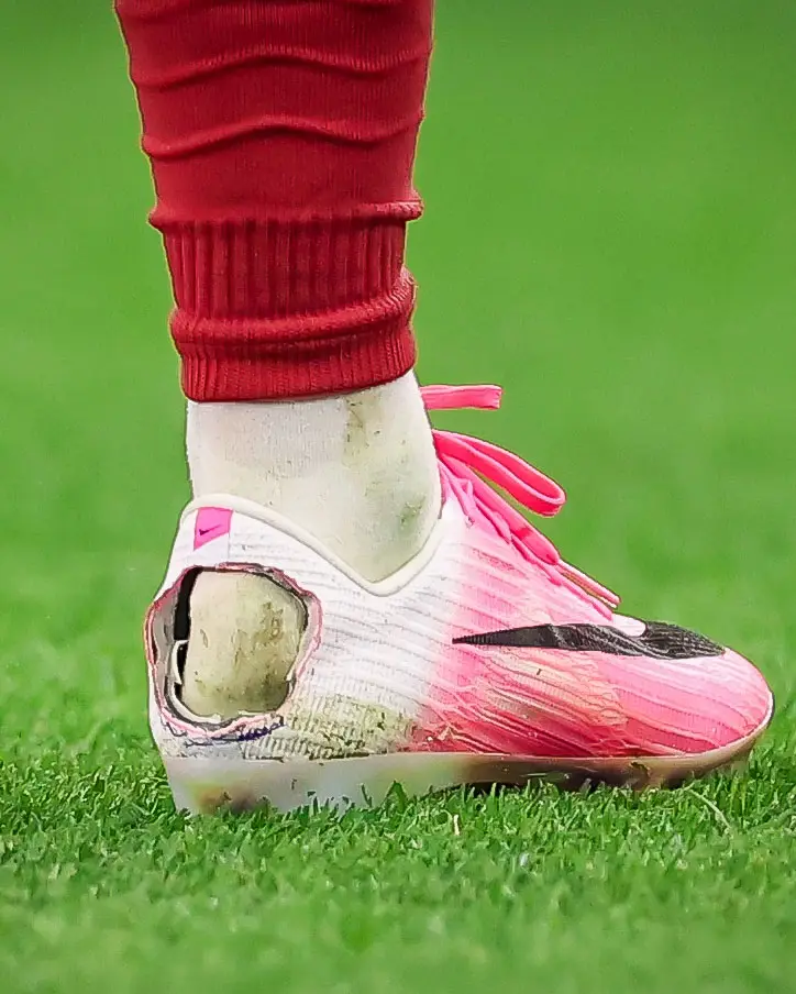 Why did Pedro Neto cut a hole in his football boot? The Haglund's deformity explained